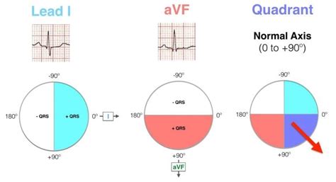 ECG Axis Interpretation • LITFL Medical Blog • ECG Library Basics