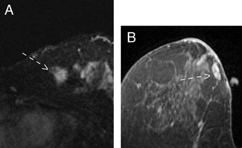 Dce Mri Of The Breast A Malignant Breast Lesion Showing Irregular