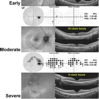 Photographic Examples Of Fundus Autofluorescence FAF Optical