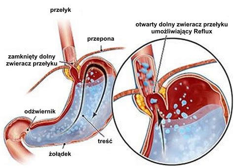 Choroby Uk Adu Pokarmowego