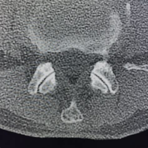 Facet joint osteoarthritis grade. (a) Grade 1 (normal): facet joint ...