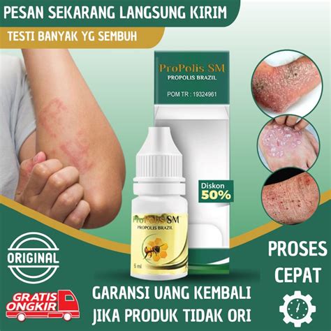 Jual Salep Kudis Obat Eksim Kering Menahun Salep Eksim Basah Obat