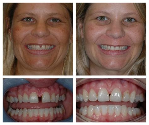 Orthodontic Smile Gallery Cosmetic Dentistry Photos Images