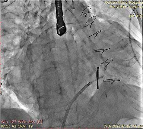 Tctap C 218 Valve In Ring Transcatheter Mitral Valve Replacement With