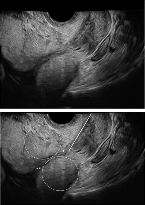 Contractions Of The Lower Uterine Segment During Transvaginal