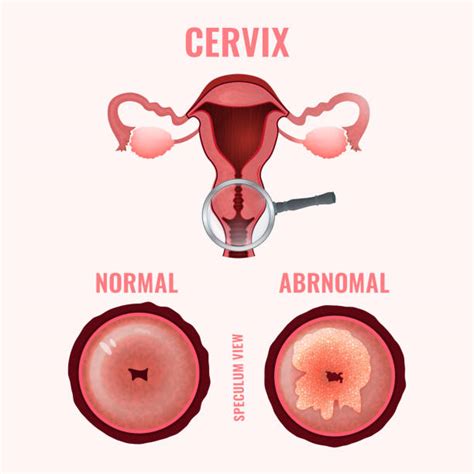 Cervical Cancer Screening Sina Health Centre