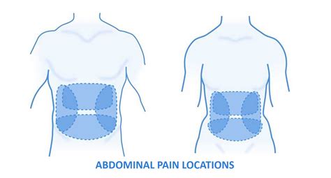 Abdominal Pain Chart And Symptoms