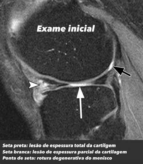 Artrose osteoartrite de joelho causas sintomas e diagnóstico