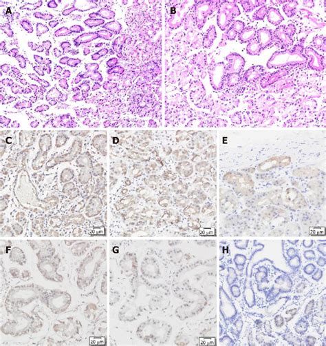 Figure 2 From Multiple Gastric Adenocarcinoma Of Fundic Gland Type A