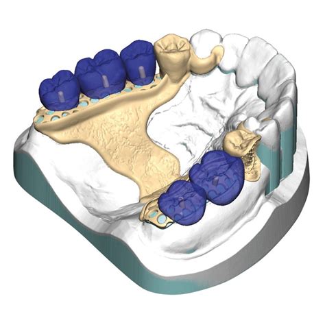 Exocad Implant Lab Bundle Flex Perpetual License Bristol Cadcam