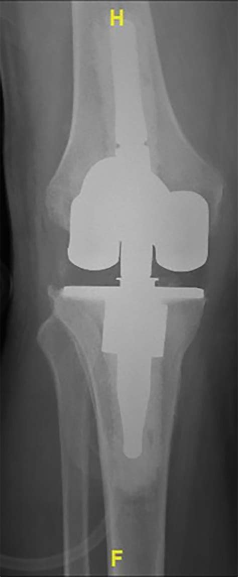 Revision Total Knee Replacement Stephen J Incavo Md