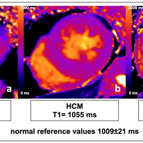 Mid Ventricular Short Axis View Of T1 Maps Modified Look Locker