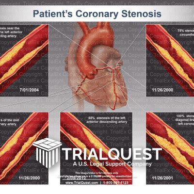 Coronary Stenosis Trialexhibits Inc