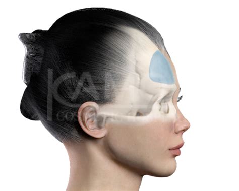 Forehead Augmentation Forehead Implant Kamol Cosmetic Hospital