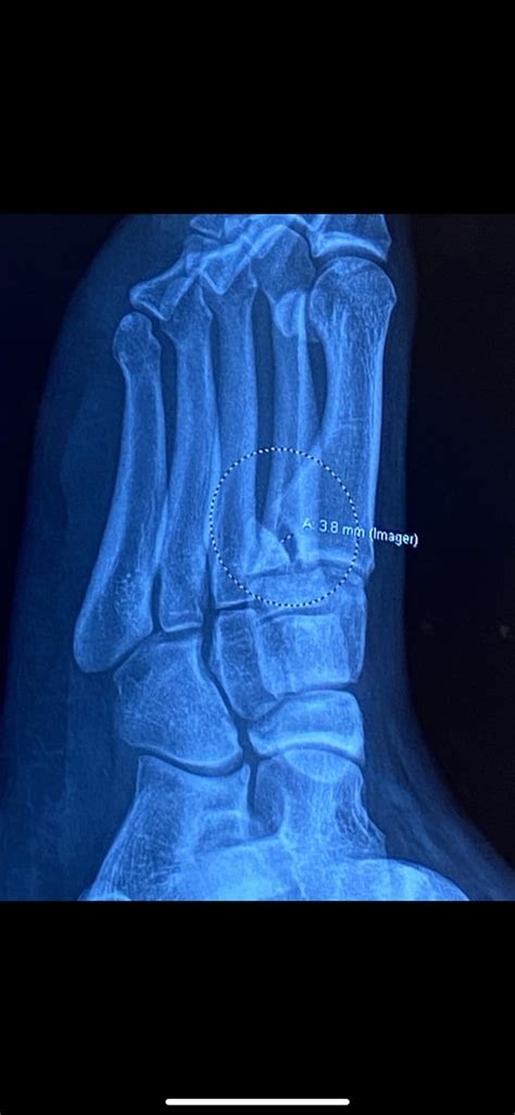 First metatarsal fracture won’t stop causing pain. It has been over one ...