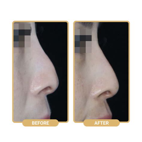 surgical nose augmentation understanding  nose thread nextmed