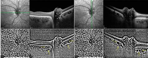 Illustration Of Peripapillary Choroidal Vascularity Index Measurement Download Scientific