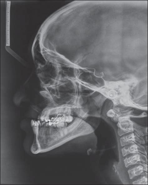 Treatment of severe maxillary cleft hypoplasia in a case with missing ...