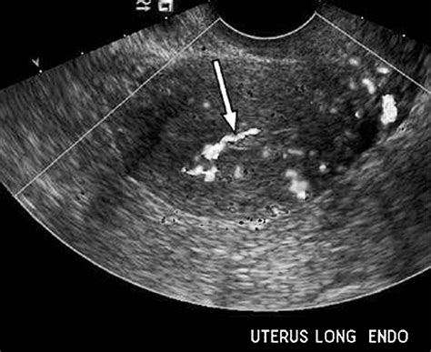 Using Transvaginal Sonography With Color Doppler Imaging For The