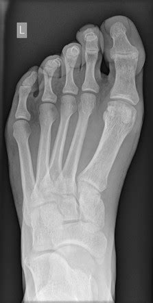 Lateral Hallux Sesamoid Avascular Necrosis Image Radiopaedia Org