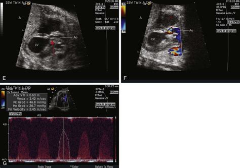 Aortic Stenosis And Mitral Valve Dysplasia Syndrome Radiology Key