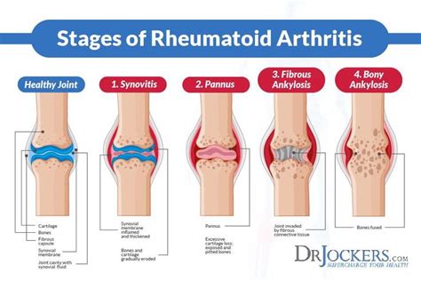 Pannus Formation Google Search Rheumatoid Arthritis Arthritis