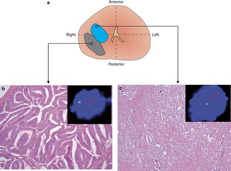 Representative Example Of Ductal Adenocarcinoma Case Hande Sections With