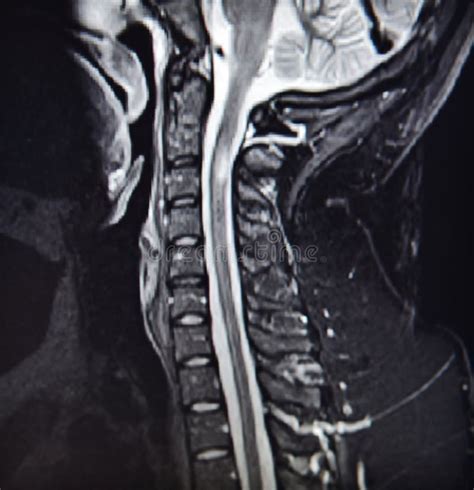 Mri of Cervical Spine Stenosis Stock Image - Image of inability ...