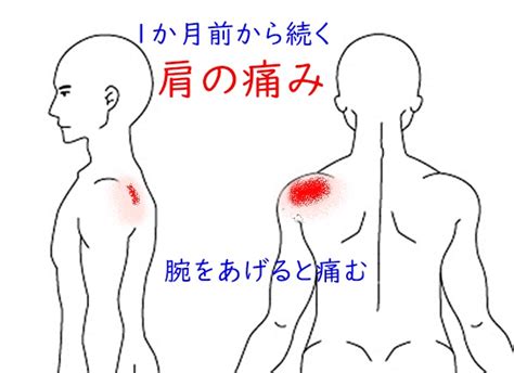 肩関節の痛み 手をあげると痛む 治療室そら 藤沢市湘南台の鍼灸院｜ハリ 鍼灸 逆子 肩こり 腰痛