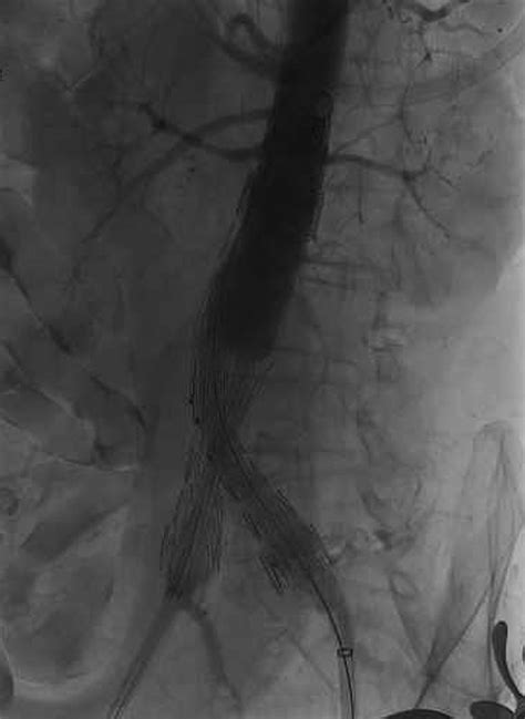 Successful Hybrid Repair For Ruptured Abdominal Aortic Aneurysm Caused