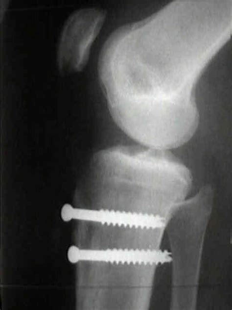 Subluxation Dislocation Of The Patella Wheeless Textbook Of