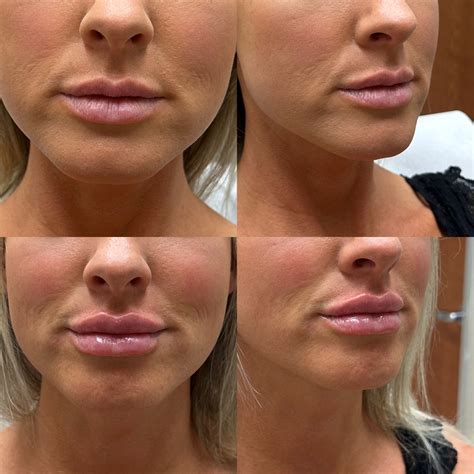 Lip Augmentation Before And After