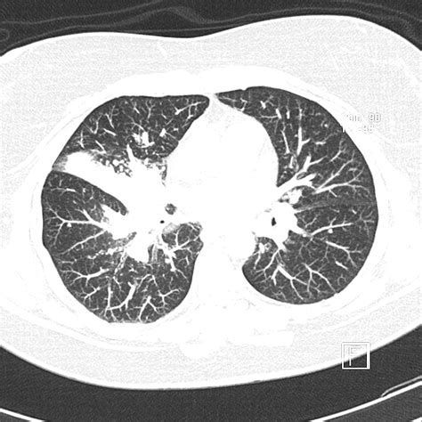 Pulmonary Cryptococcosis Image