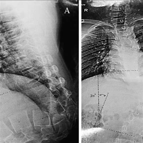 A Lat X Ray Thoracolumbar Spine Measuring Sagittal Cobb S Angle