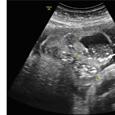 Ultrasound Of The Enlarged Fetal Scrotum At 33 Weeks Gestation