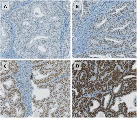 Mre11 Protein Expression In Endometrial Carcinomas As Assessed By