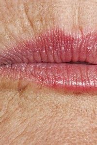 Upper Lip Wrinkling Treatment Options