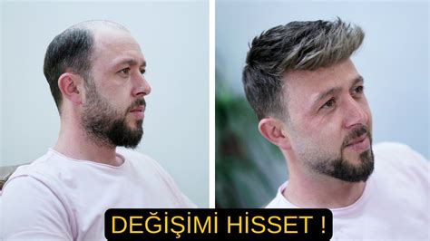 Protez Saç İle Değişimi Hisset Hair Replacement YouTube