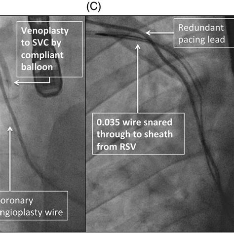 Stages of the procedure. (A) Venogram of SVC occlusion. (B) Venoplasty ...