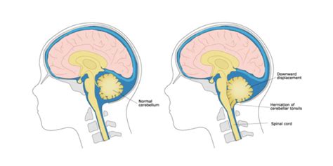 Diagram Chiari Malformation Treatment Propel Physiotherapy Propel