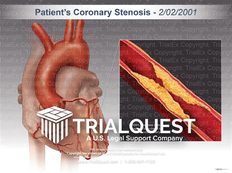 Coronary Stenosis Trialquest Inc