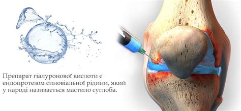 Гіалуронова кислота - Orthodoc