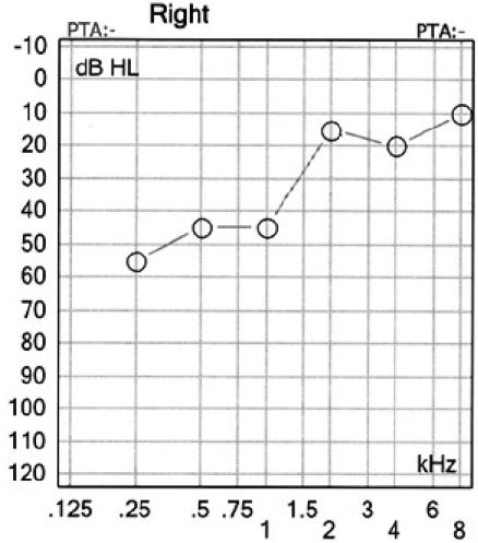 Pure Tone Hearing Thresholds In The Right Ear Following The Day Of