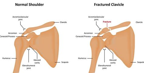 Clavicle Fracture Treatment in Boulder, CO | Broken Collarbone ...