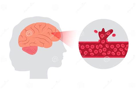 Brain Stroke Hemorrhagic Stock Vector Illustration Of Cell 224092725