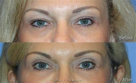 Lower Blepharoplasty Gone Wrong