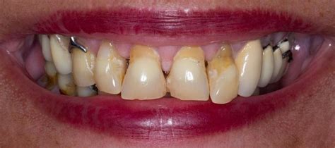 Teeth Before And After Dentures Lakeland Dentures Near Me