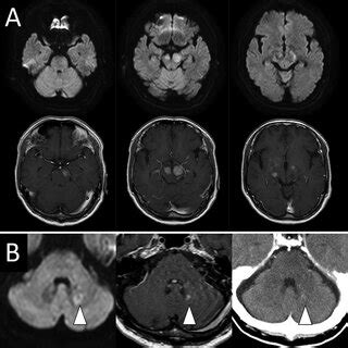 A Axial Diffusion Weighted Upper And Postcontrast T1 Weighted