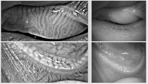 The Meibomian glands exist within the eyelids and produce the oily ...