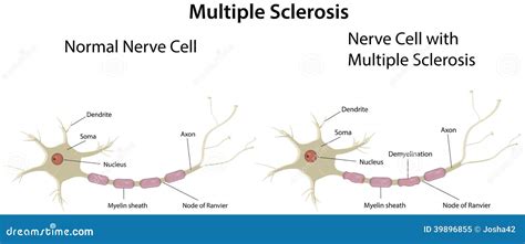 Multiple Sclerosis Diagram Stock Vector Image 39896855